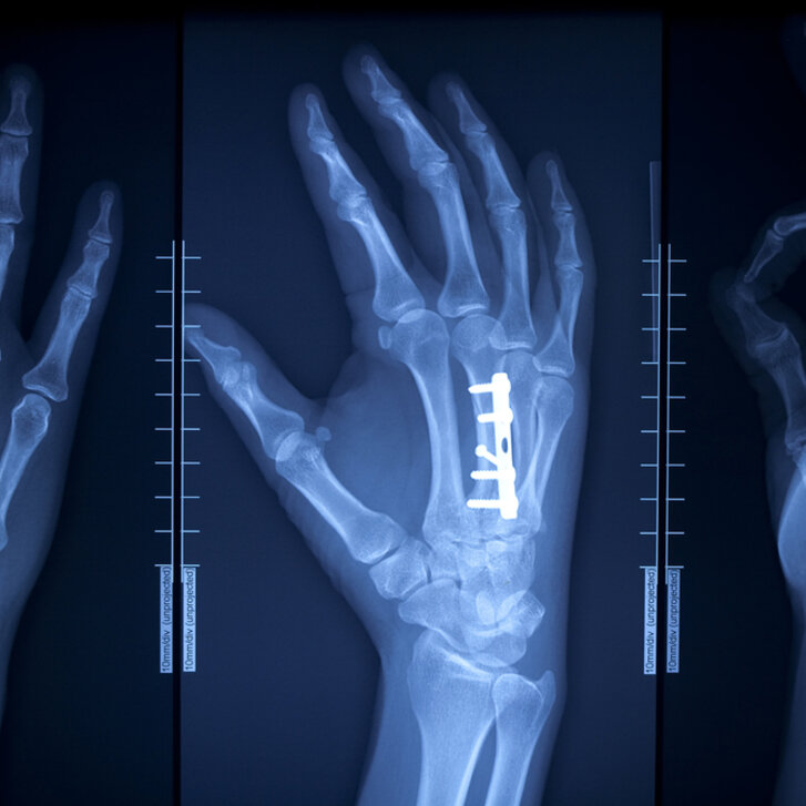 Röntgen Hand