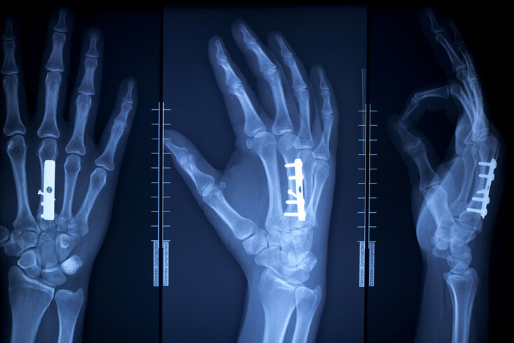 Röntgen Hand