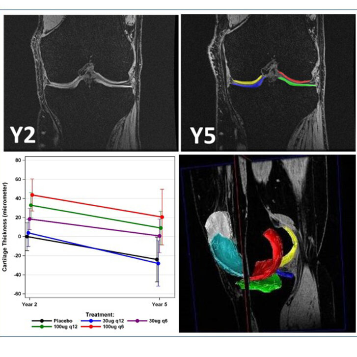 Follow-up study highlights the potential of sprifermin therapy for knee osteoarthritis